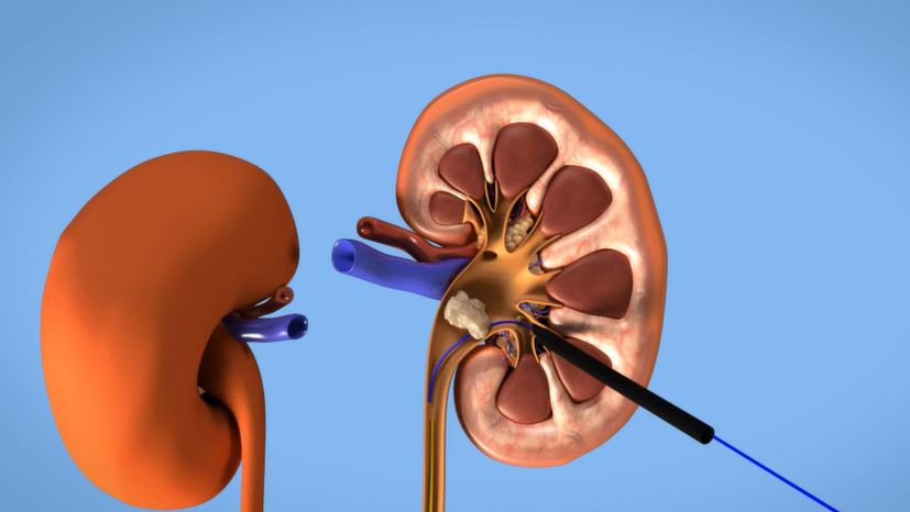 PCNL Treatment