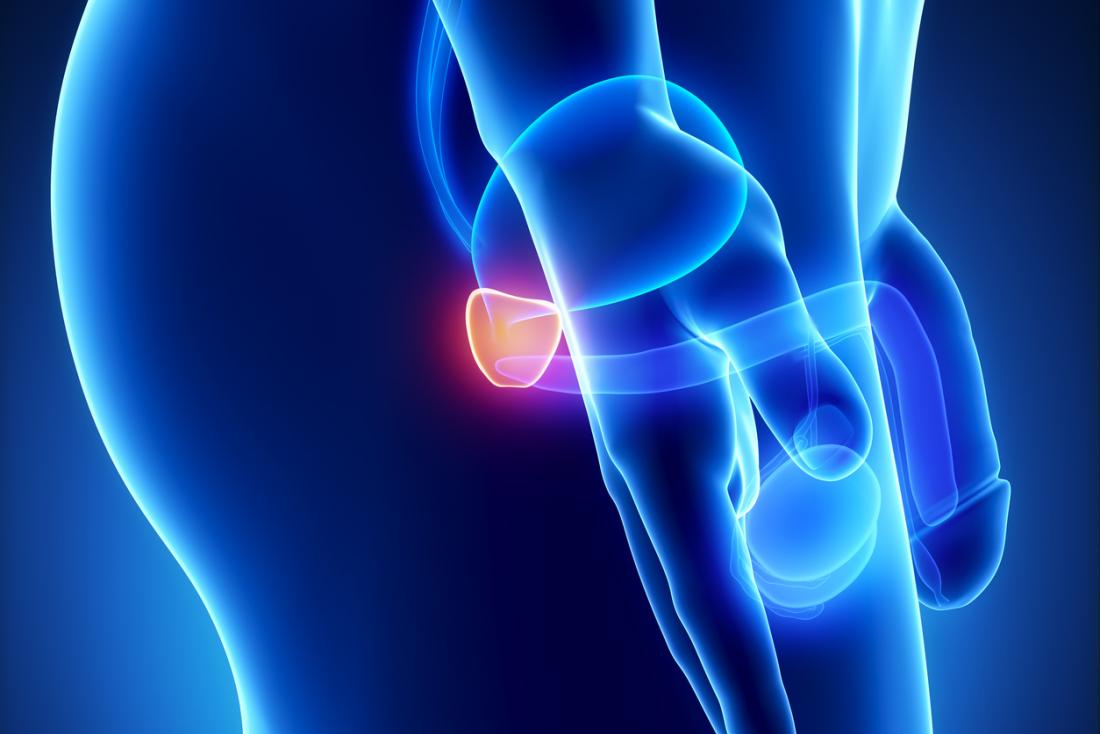 prostate cancer