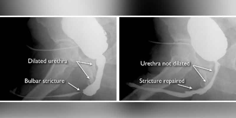 Best Surgeon for Urethroplasty