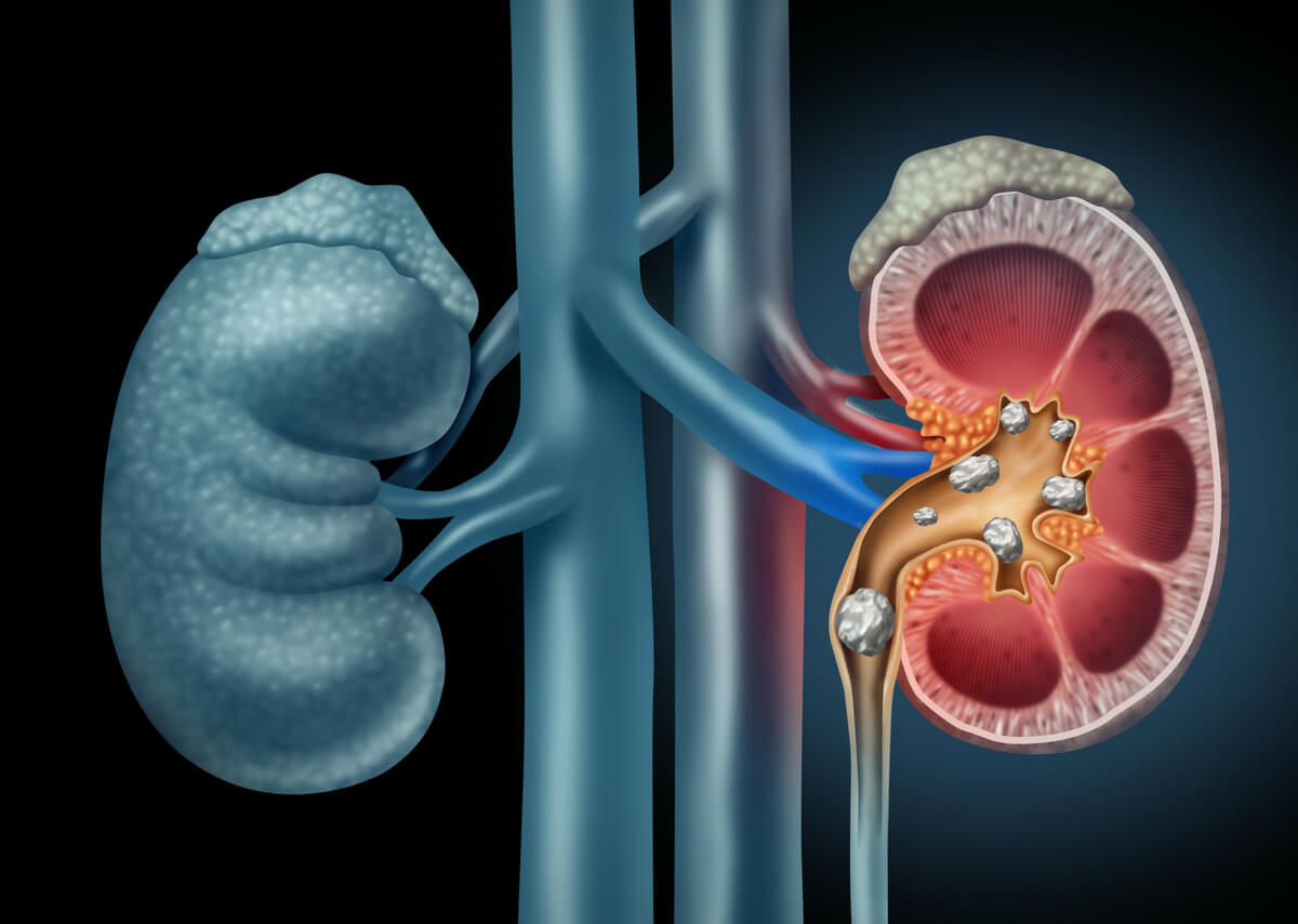 Kidney Stones Treatment