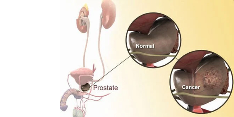 Prostate Cancer 