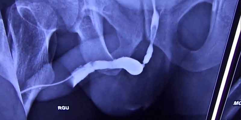 Urethral Stricture Surgery Treatment
